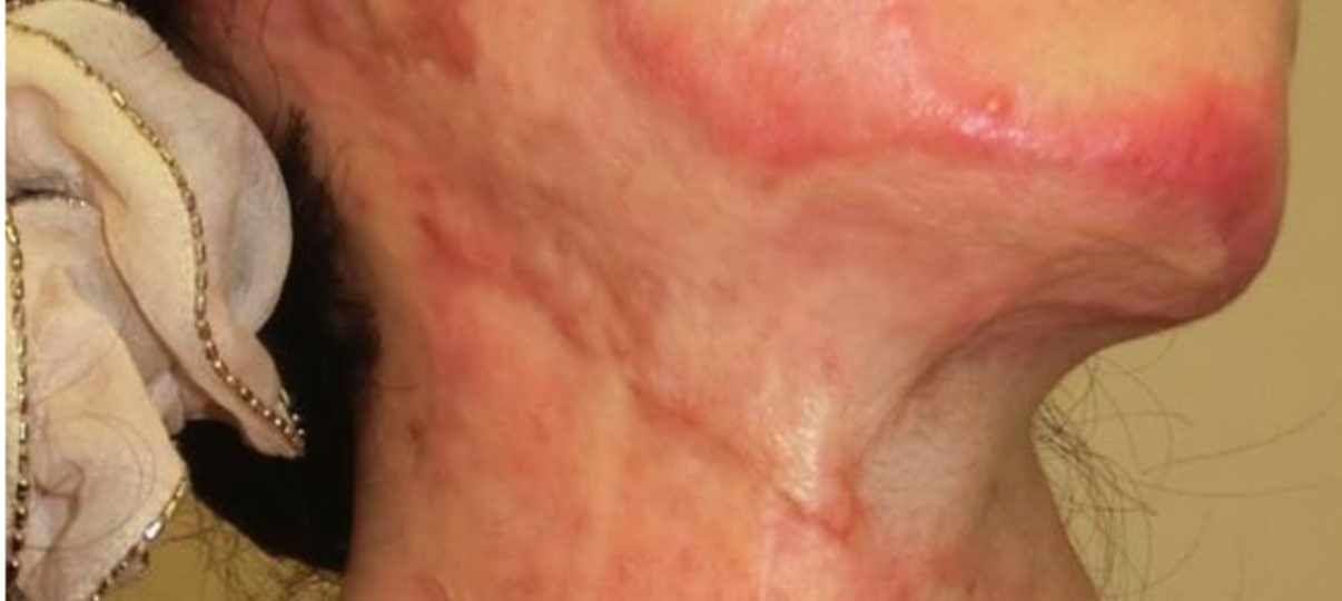 Before Treatment