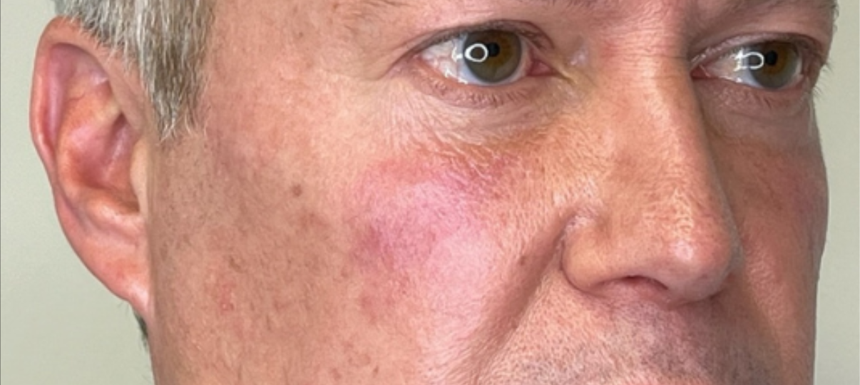 Before Treatment