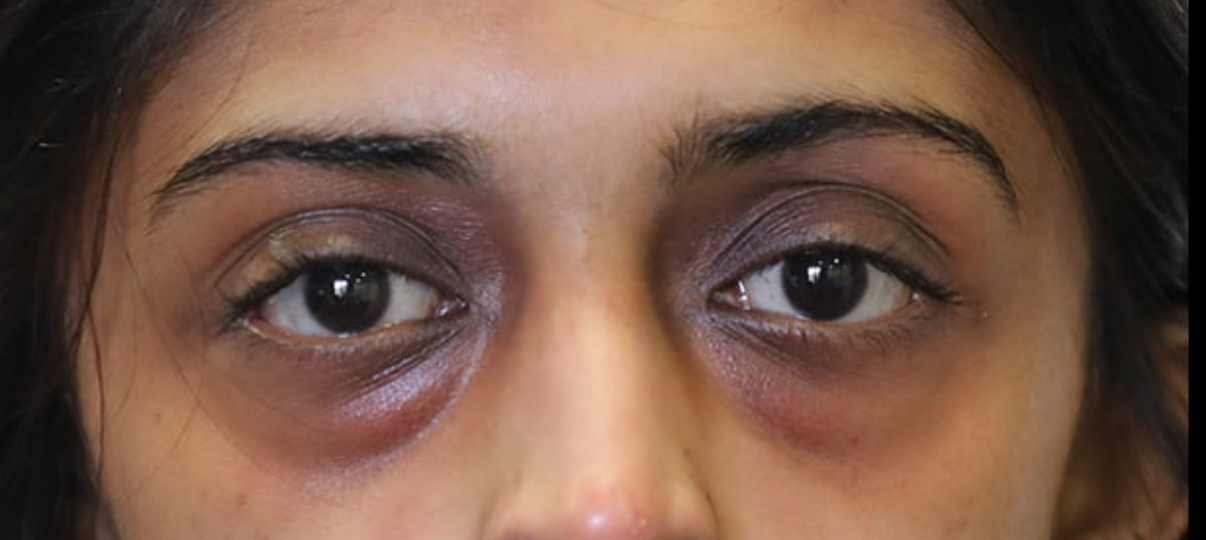 Before Treatment
