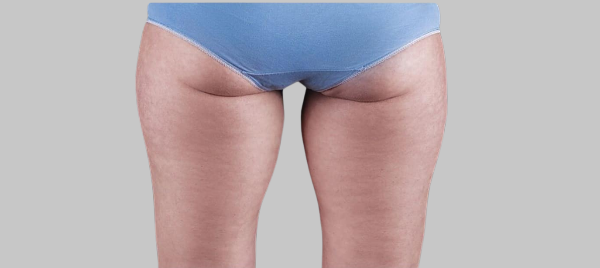 After Treatment