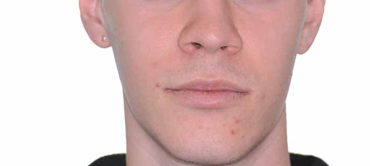 After Treatment