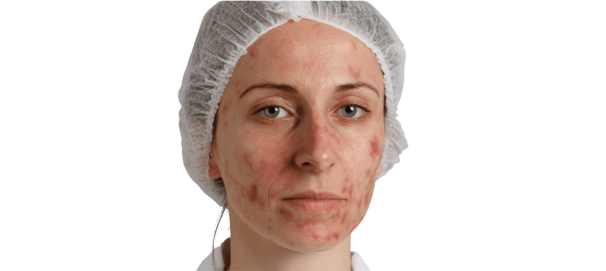 Before Treatment