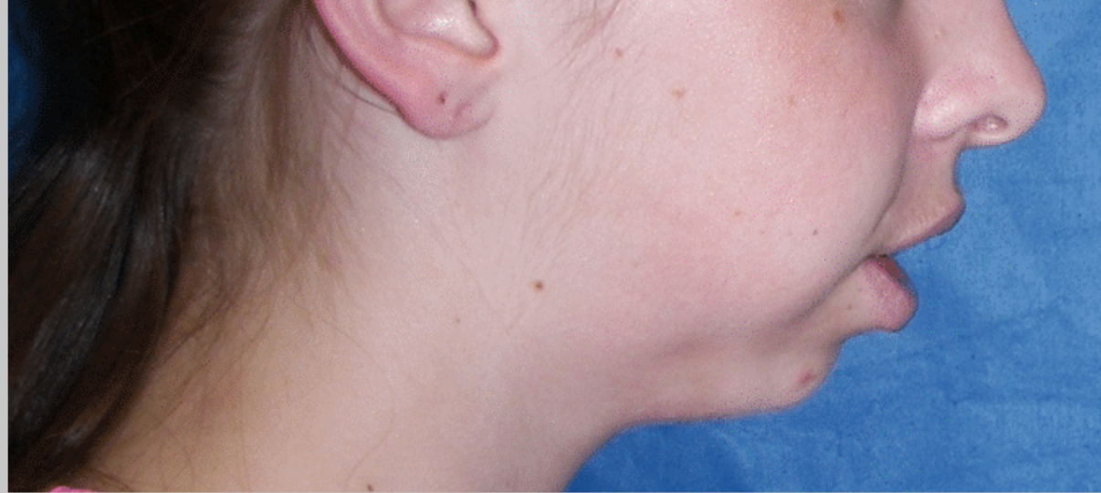 Before Treatment