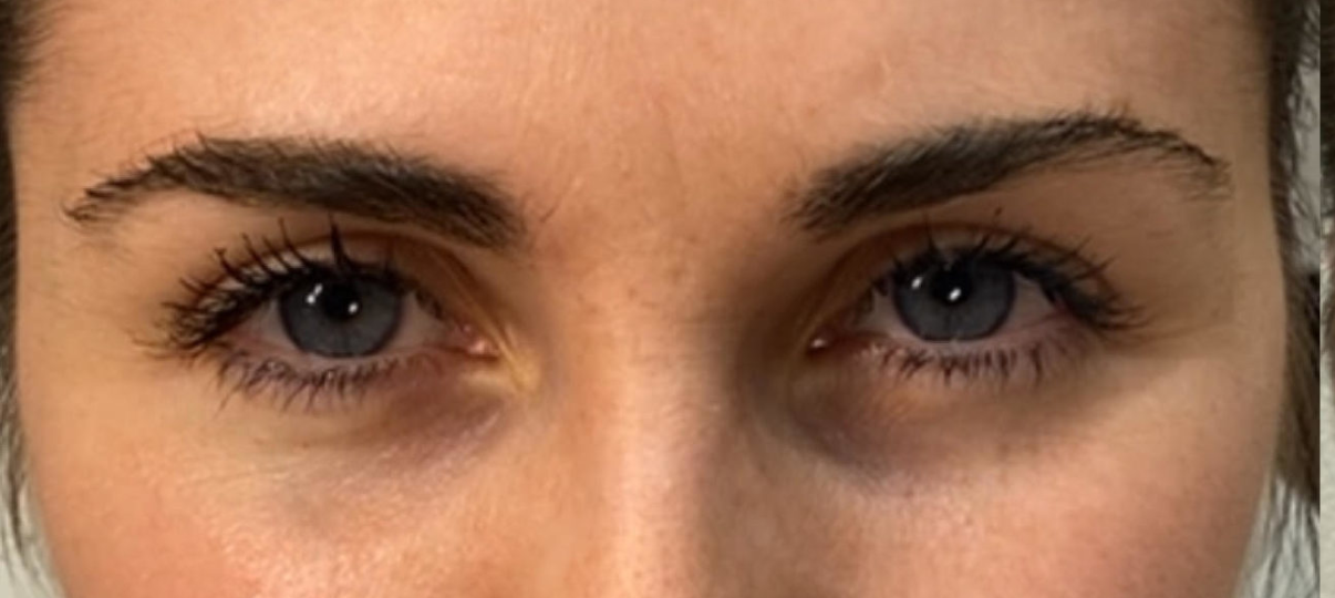 Before Treatment