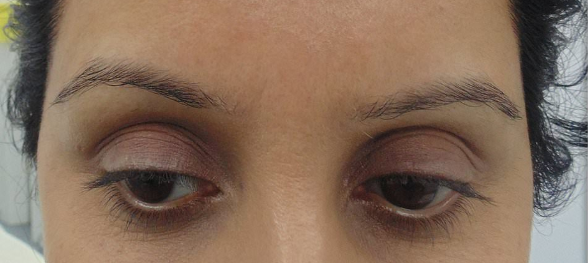 Before Treatment