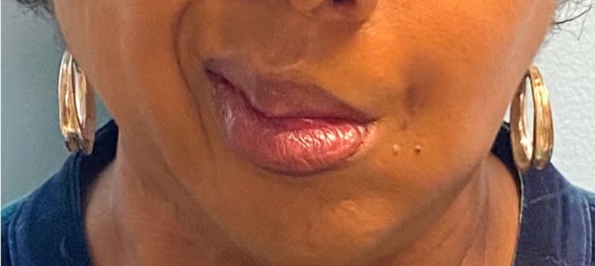 Before Treatment