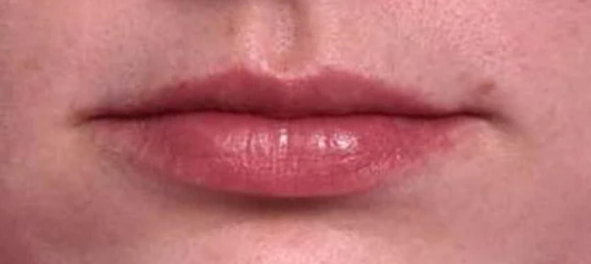 Before Treatment