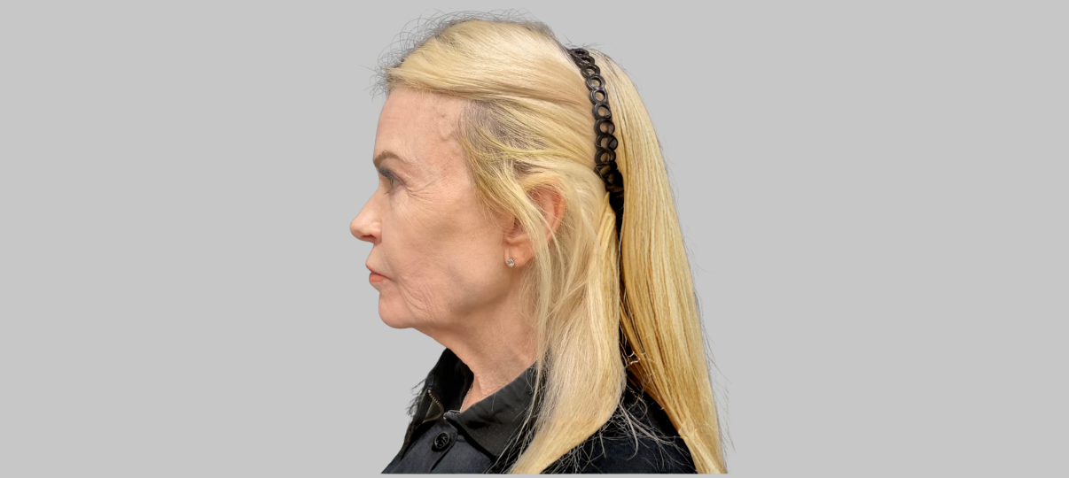 Before Treatment