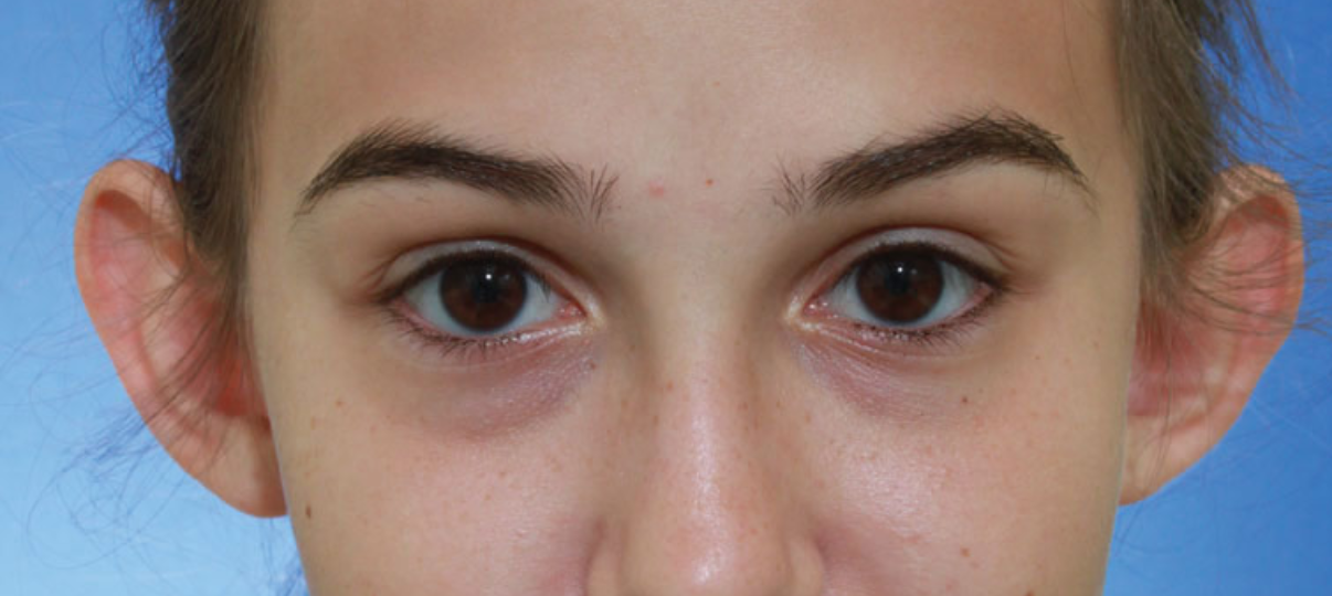 Before Treatment