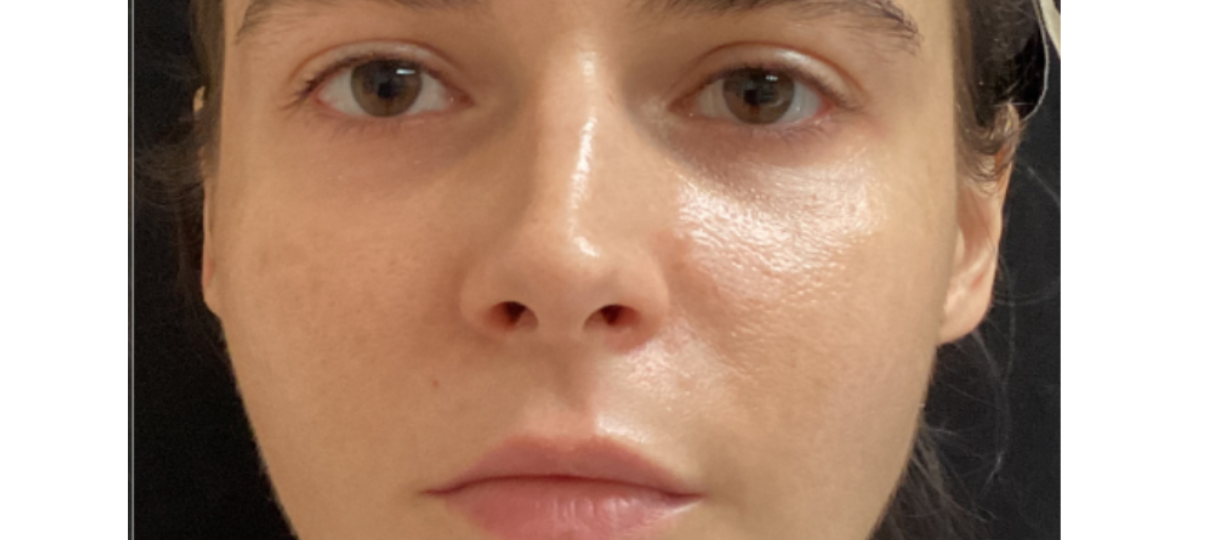 After Treatment