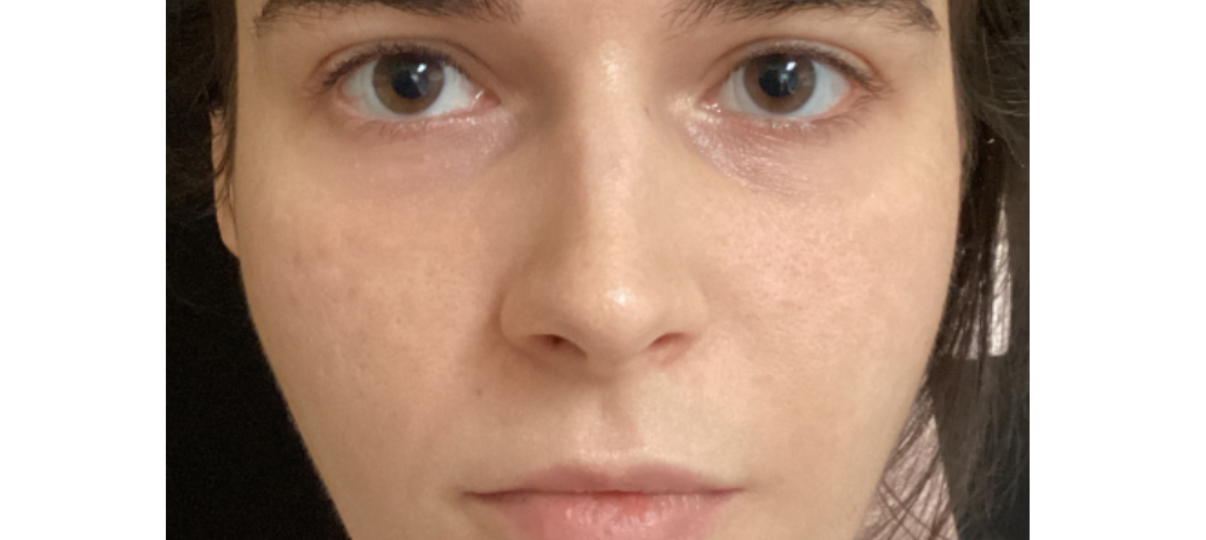 Before Treatment