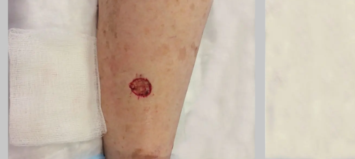 Before Treatment