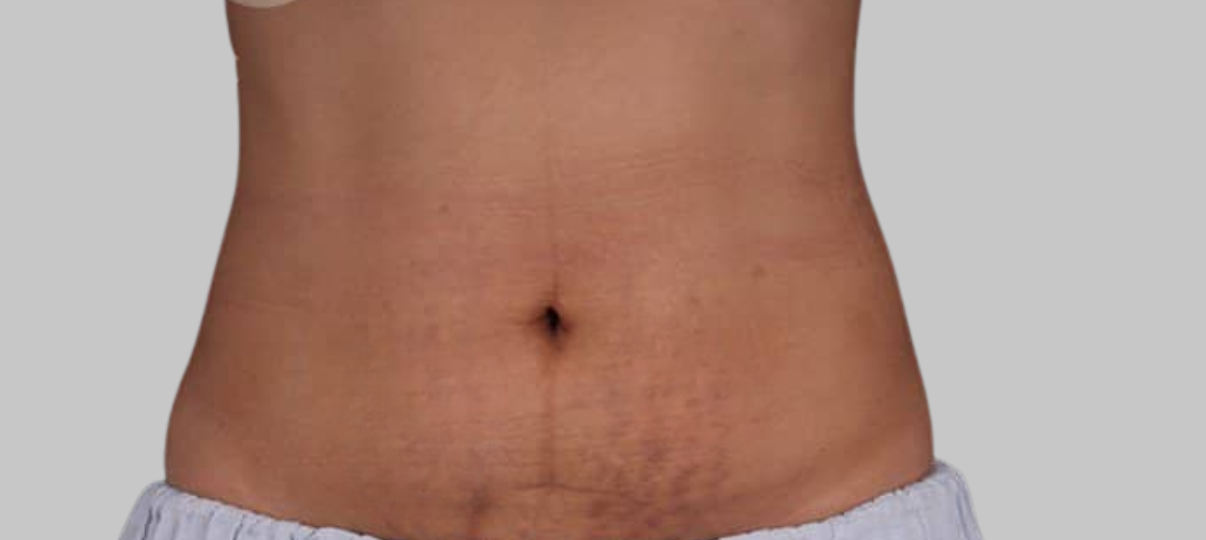 After Treatment