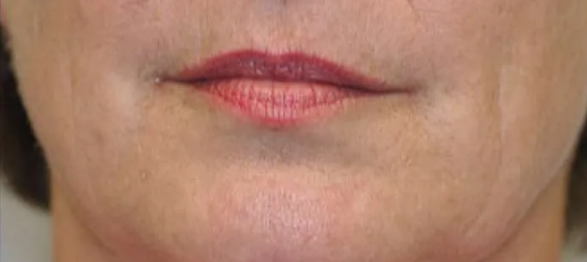 After Treatment