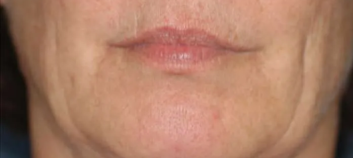 Before Treatment