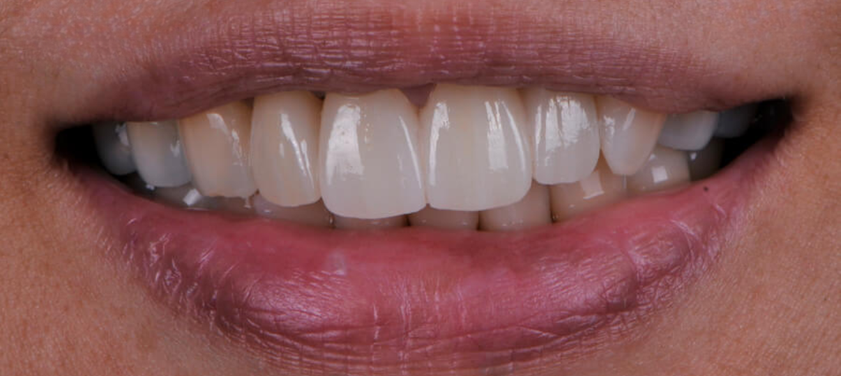 After Treatment