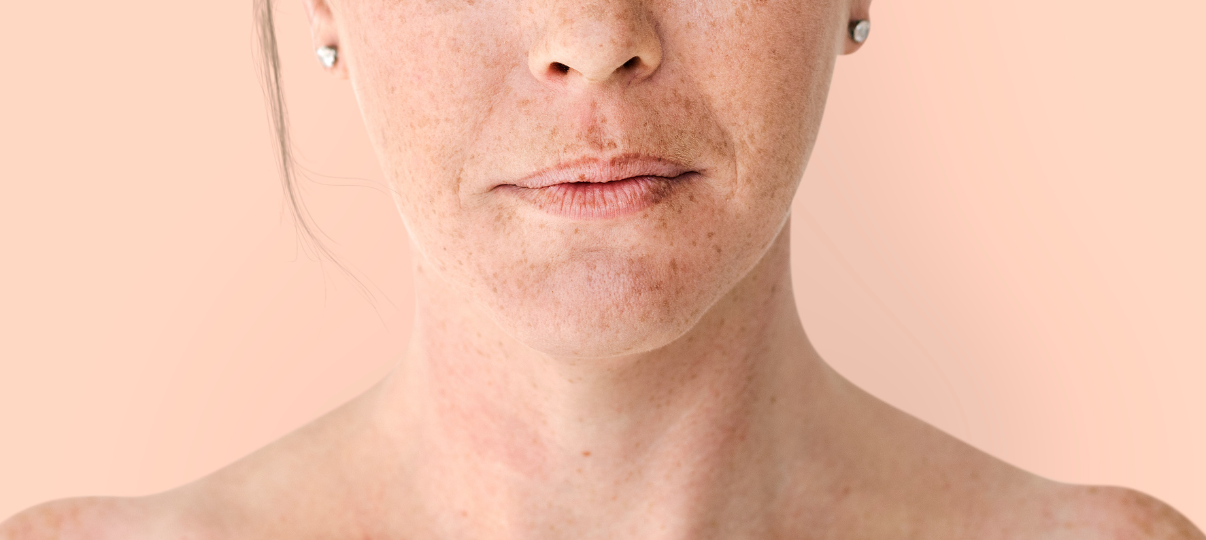 Before Treatment