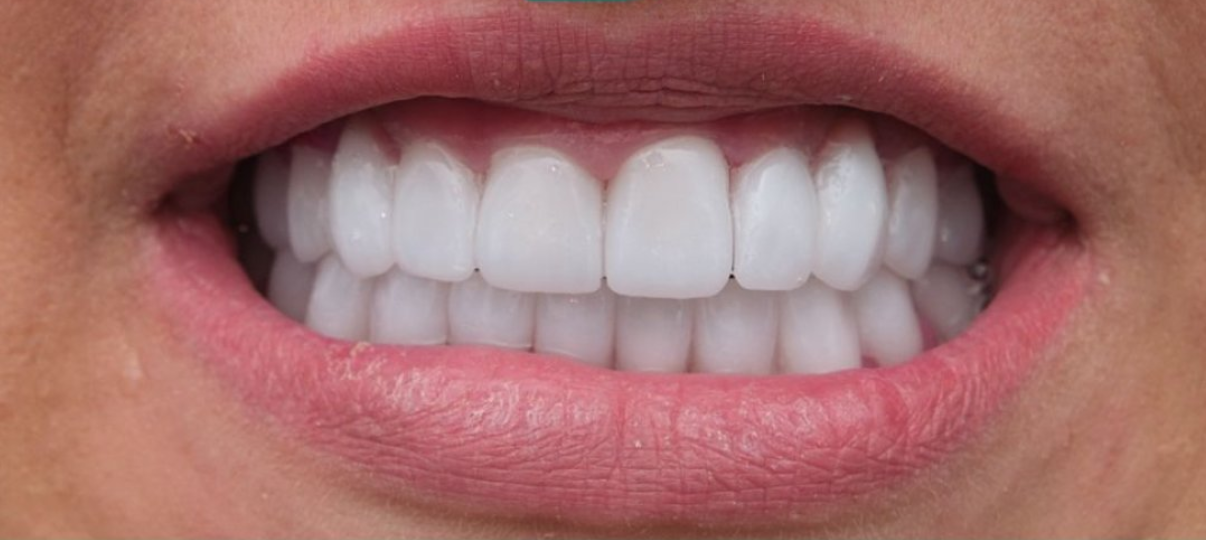 After Treatment