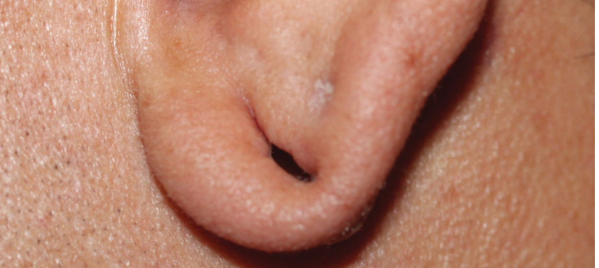 Before Treatment