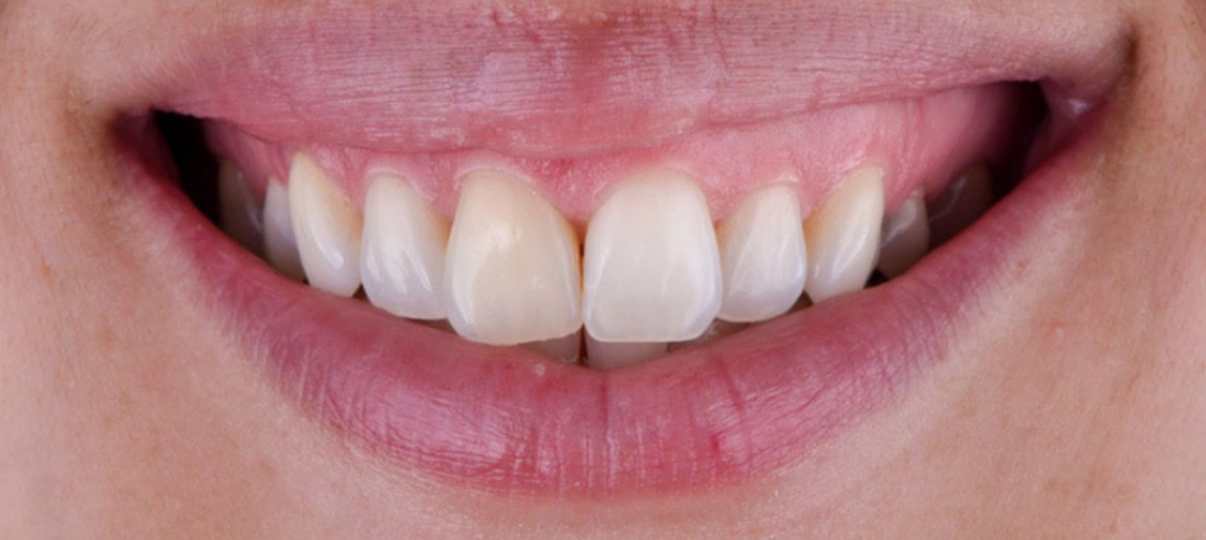 Before Treatment