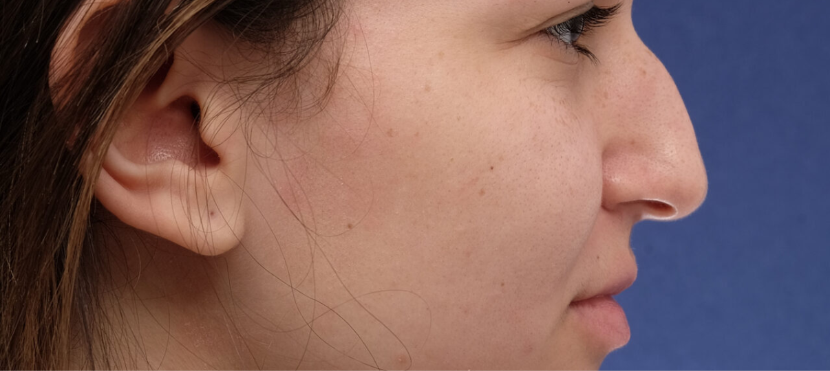 Before Treatment